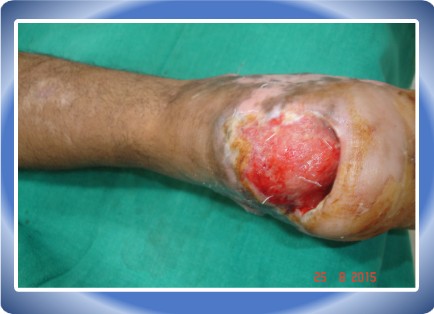 HEEL DEFECT